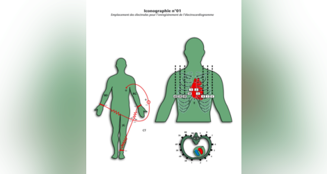 [astuce]:comment enregistrer et interpréter un ECG-NOTIONS ÉLÉMENTAIRES 